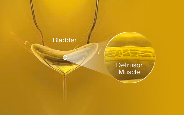 MYRBETRIQ Mechanism of Action Step 1: Defining Overactive Bladder