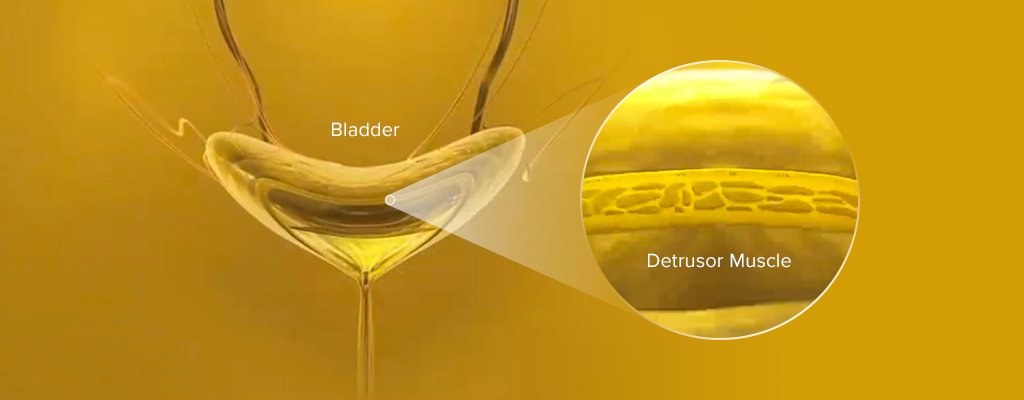 MYRBETRIQ Mechanism of Action Step 1: Defining Overactive Bladder